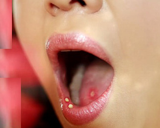 Bỏng ở khoang miệng